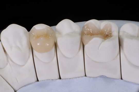 長門市の歯科でジルコニアセラミックなら、田中歯科医院